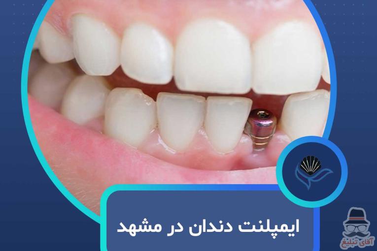 ایمپلنت دندان در مشهد  با اقساط بلندمدت و شرایط ویژه