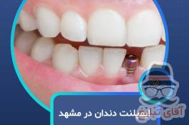 ایمپلنت دندان در مشهد  با اقساط بلندمدت و شرایط ویژه