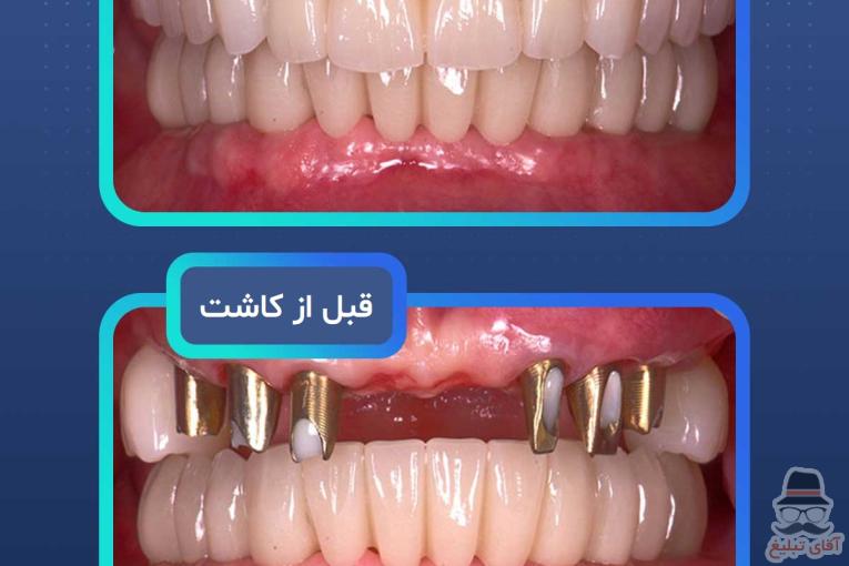 ایمپلنت دندان در مشهد  با اقساط بلندمدت و شرایط ویژه
